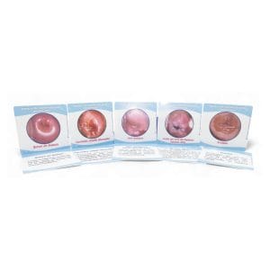 Set 5 láminas acrílico 20x20 Patologías aparato reproductor femenino